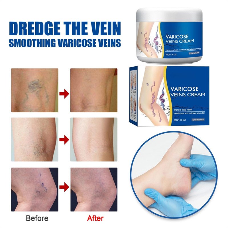 Varicose Veins Cream