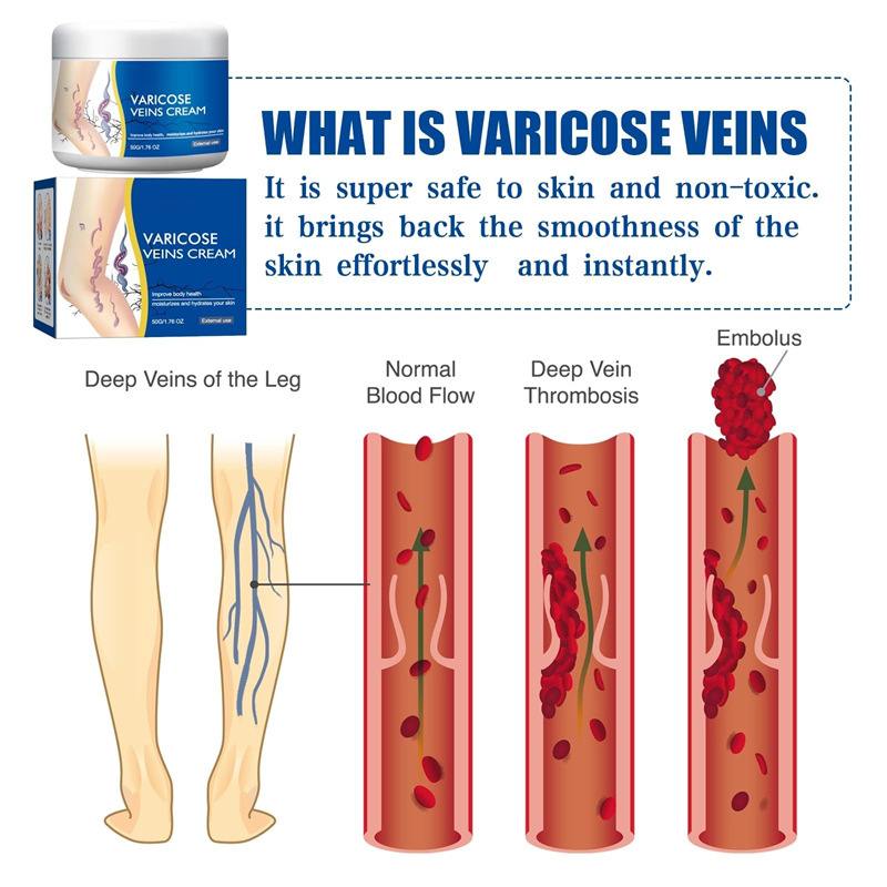 Varicose Veins Cream